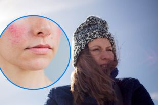 Изгаряне от вятър: Ефективно лечение и за кои хора е най-опасно