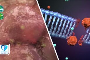 Как да открием и предотвратим навреме рака на дебелото черво?