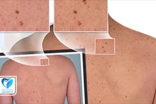 Нови методи за диагностика и контрол на рака на кожата