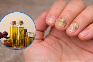 14 натурални средства срещу гъбички по ноктите