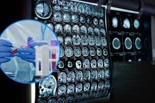 Кръвен тест открива Алцхаймер години преди загуба на паметта