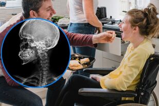 Какво е Синдром на Неймеген: Рядко генетично заболяване с висок риск към рак