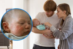 Какво е бебешко акне и как се лекува: Как изглежда и притеснително ли е