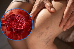 Кръвен съсирек: Какво го причинява и опасно ли е