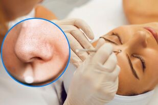 Черни точки по лицето: Как да ги премахнете безопасно и лесно у дома