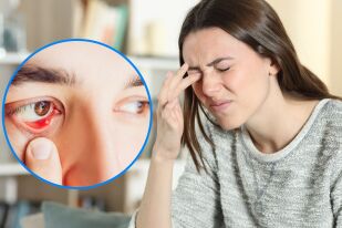 Защо вътрешният ечемик на окото може да е опасен и как да го лекувате