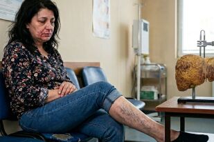 Кожата издава смъртоносно чернодробно заболяване