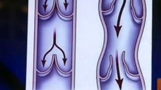 Разширени вени и варикозни язви се лекуват