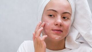 Пробиотици при акне? Ето как помагат