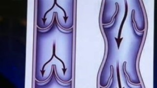 Разширени вени се предотвратяват с ходене пеш