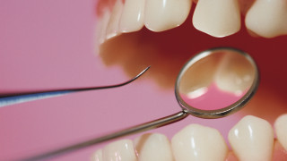 Зъбни импланти вместо кастанетки