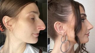 Тотална промяна! Жена харчи 11 хил. долара за операция на носа (СНИМКИ)