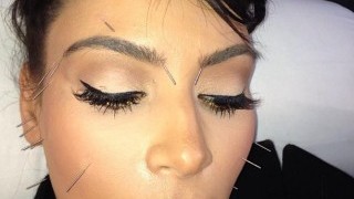 Ким Кардашиян се подложи на китайска акупунктура