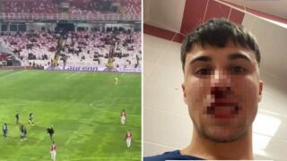 И се лее кръв: Счупиха с кроше носа на италиански футболист (ВИДЕО)