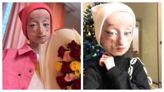 Историята на Аня - момичето, което остарява твърде бързо (СНИМКИ)