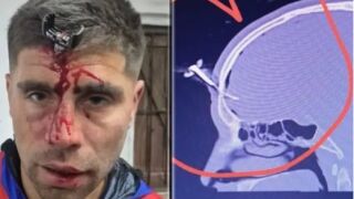 12 часа ужас: Бивш футболист оцеля след атака с гаечен ключ в главата