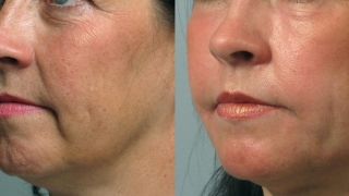 Какво е FaceTite и как подмладява лицето?