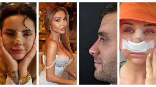 Кои дами от "Ергенът" и "Ергенът" Любов в рая" коригираха носа си! И един мъж в списъка (СНИМКИ)