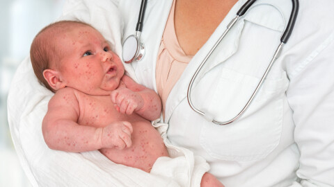 Морбили продължава да настъпва, нови случаи са регистрирани във Враца и Плевен