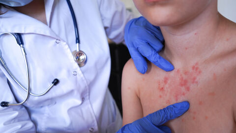 Продължават да се увеличават случаите на морбили в България – вече са 61