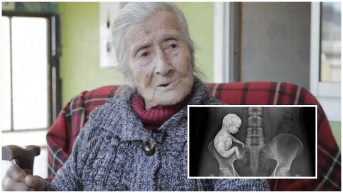 Историята на „вкамененото“ бебе: Възрастна жена разбира, че е била бременна 60 г. по-късно  