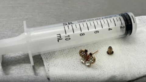 Оперираха 10-месечно бебе, погълнало обеца 