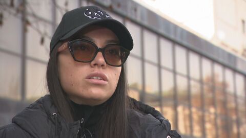 "Не мога да опиша болките": Млада жена е с изгаряния след процедура в салон за красота