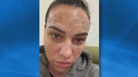 Отнета е регистрацията на салона, в който жена получи втора степен изгаряния