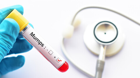 17 деца са болни от морбили в област Враца