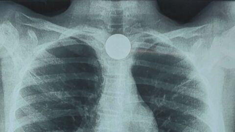 9-годишно дете погълна монета, която се заклещи в хранопровода ѝ (ВИДЕО)