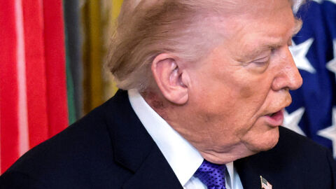 Тръмп е подложен на превантивно лечение заради обрив на врата, заяви неговият лекар