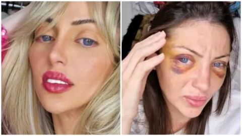 31-годишна жена почина след 27 пластични операции - искала да бъде Барби (СНИМКИ)