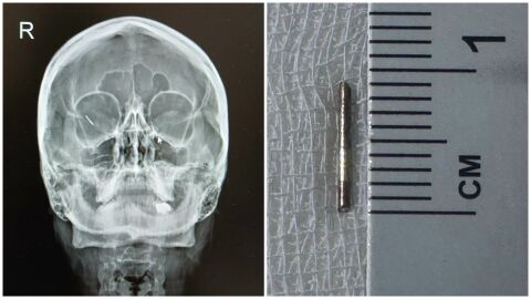 Спешна операция спаси зрението на млада жена с 10-милиметрова шнола в окото