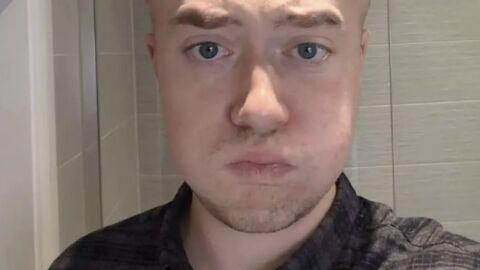 „Приличах на Мегаум, челото ми се поду, бях с насинени очи“: Мъж се подложи на интервенция с неочакван край 