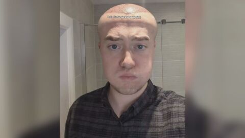 „Приличах на Мегаум, челото ми се поду, бях с насинени очи“: Мъж се подложи на интервенция с неочакван край 