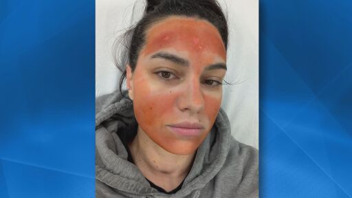 "Не мога да опиша болките": Млада жена е с изгаряния след процедура в салон за красота