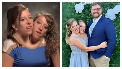 Снимка Как живеят днес сиамските близначки Хенсел – едната от които се омъжи и стана майка (СНИМКИ)