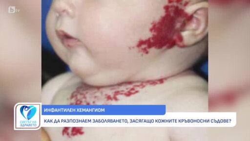 Снимка Инфантилен хемангиом: Какво се крие зад диагнозата? (ВИДЕО)