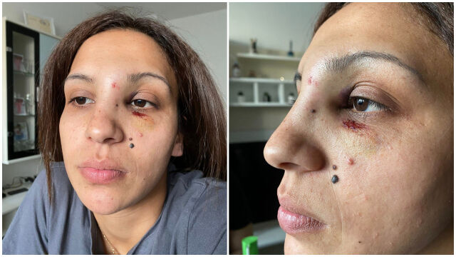 Снимка: „Искаше да ме убие“ - ограничителна заповед за бившия съпруг на пребита жена