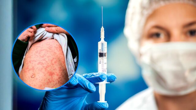 Снимка: Няма лечение за Морбили: Ваксинацията предотвратява 94 млн. смъртни случая