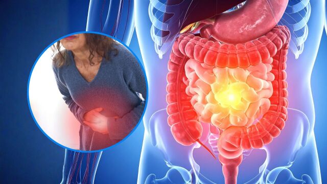 Снимка: Какви са видовете рак на дебелото черво и кой е най-опасен