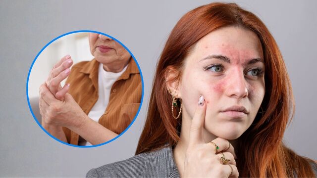 Снимка: Лупус: Какво го причинява и защо засяга предимно жените?