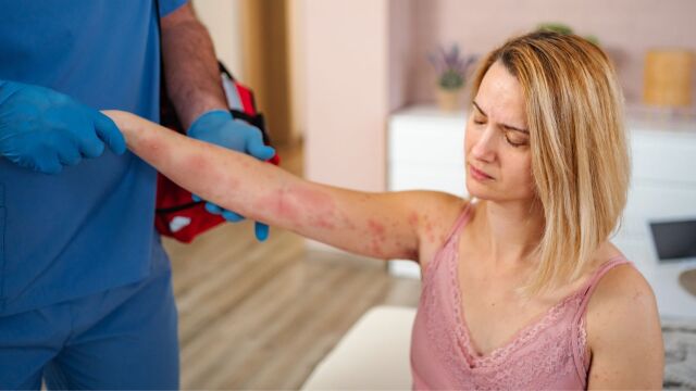 Снимка: Защо хроничната уртикария е толкова трудна за диагностициране