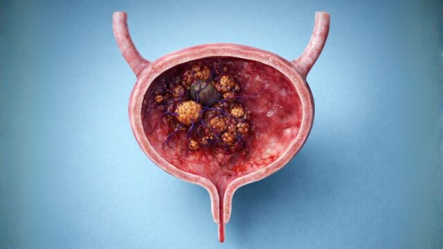 Снимка: Какви са видовете рак на пикочният мехур