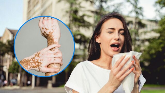 Снимка: Каква е връзката между алергиите и автоимунните заболявания?