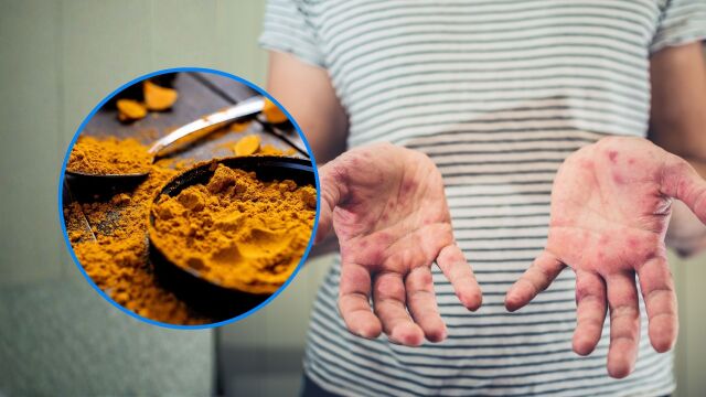 Снимка: Лечение на лупус: 6 естествени начина за облекчаване на симптомите