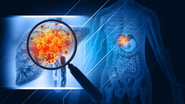 Снимка: Какво представлява ракът на черния дроб
