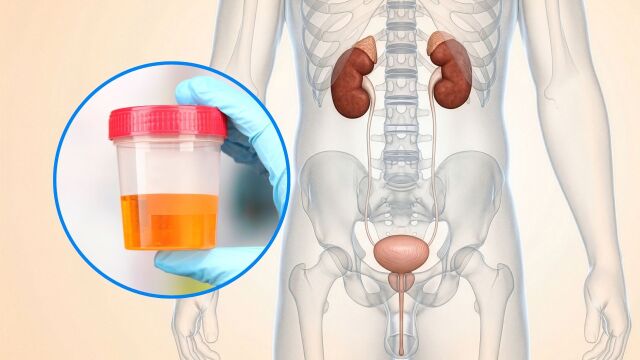 Снимка: 5 ранни признака на рак на пикочния мехур, които не бива да подценявате