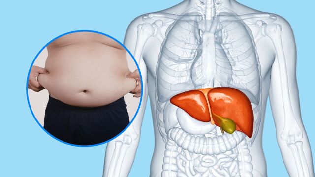 Снимка: Почти 2 млрд. души ще се разболеят от чернодробни заболявания до 2050 г.
