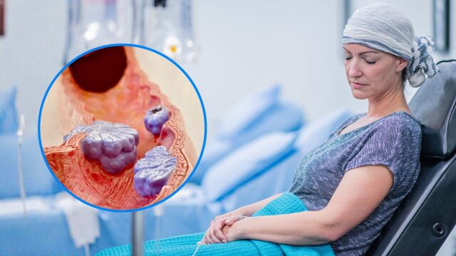 Снимка: Какво е аденокарциномът: Колко опасен е злокачественият рак